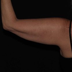 CoolSculpting Before & After Patient #736