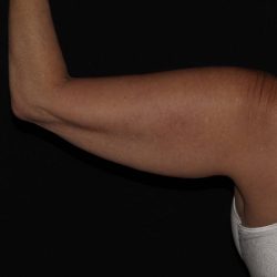 CoolSculpting Before & After Patient #736