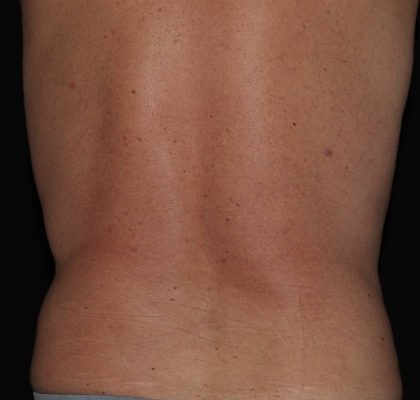 CoolSculpting Before & After Patient #737