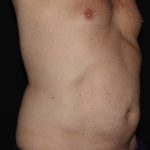 CoolSculpting Before & After Patient #737