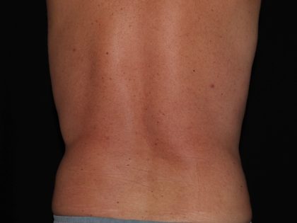 CoolSculpting Before & After Patient #967