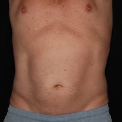 CoolSculpting Before & After Patient #967