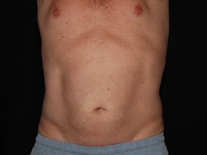 CoolSculpting Before & After Patient #967