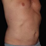 CoolSculpting Before & After Patient #967