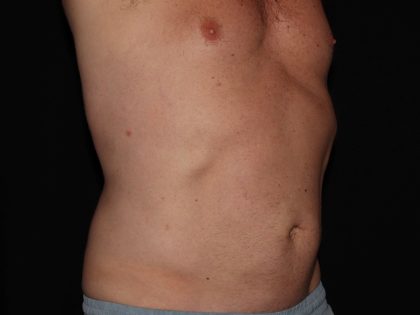 CoolSculpting Before & After Patient #967