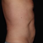 CoolSculpting Before & After Patient #967