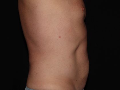 CoolSculpting Before & After Patient #967