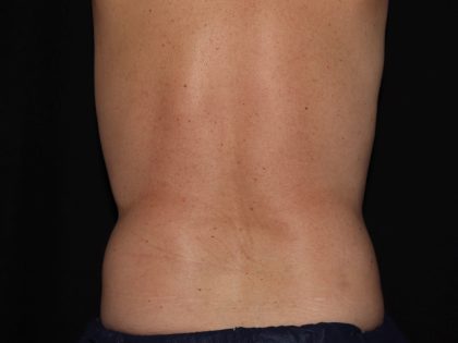 CoolSculpting Before & After Patient #967