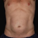 CoolSculpting Before & After Patient #967