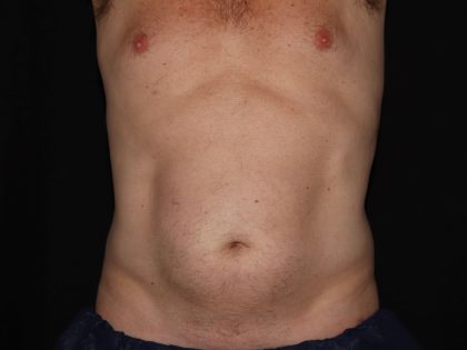 CoolSculpting Before & After Patient #967