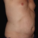 CoolSculpting Before & After Patient #967