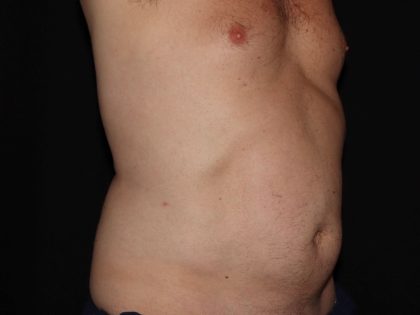 CoolSculpting Before & After Patient #967