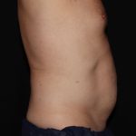 CoolSculpting Before & After Patient #967