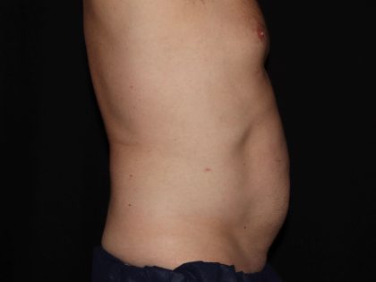 CoolSculpting Before & After Patient #967