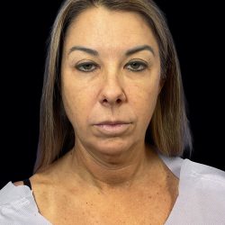 Deep Plane Facelift & Necklift Before & After Patient #1495