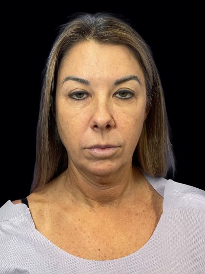 Deep Plane Facelift & Necklift Before & After Patient #1495