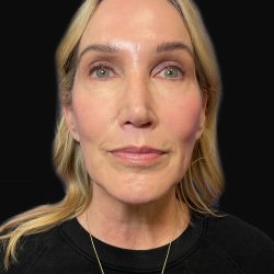 Deep Plane Facelift & Necklift Before & After Patient #1496