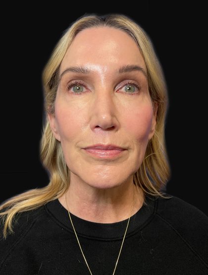 Deep Plane Facelift & Necklift Before & After Patient #1496