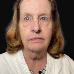 Deep Plane Facelift & Necklift Before & After Patient #1497