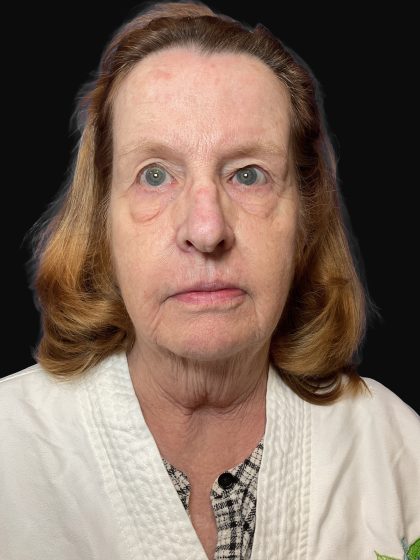 Deep Plane Facelift & Necklift Before & After Patient #1497