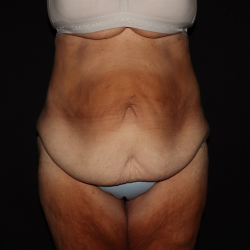 Weight Loss Before & After Patient #1345