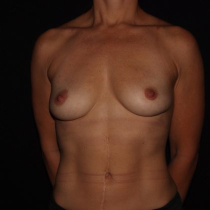 Breast Augmentation Before & After Patient #1408