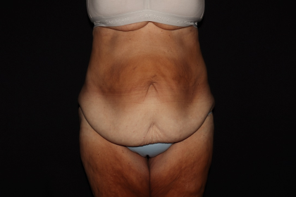 Weight Loss Before & After Patient #1345