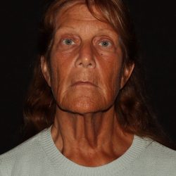 Deep Plane Facelift & Necklift Before & After Patient #1405
