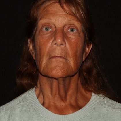 Deep Plane Facelift & Necklift Before & After Patient #1405