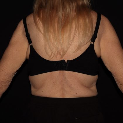 Weight Loss Before & After Patient #1402