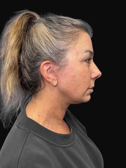 Deep Plane Facelift & Necklift Before & After Patient #1495
