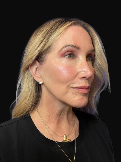 Deep Plane Facelift & Necklift Before & After Patient #1496