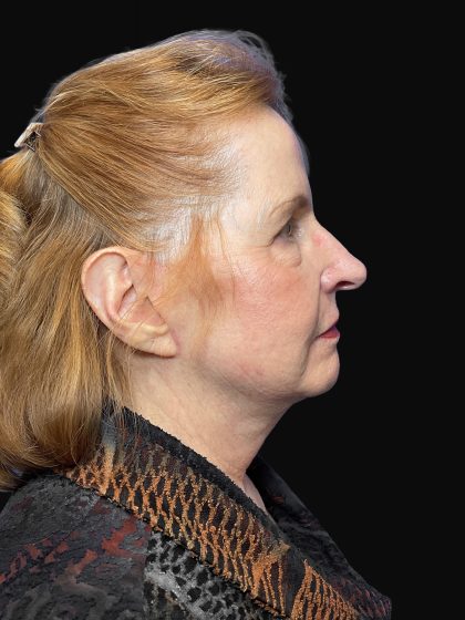 Deep Plane Facelift & Necklift Before & After Patient #1497