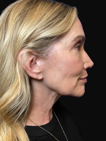 Deep Plane Facelift & Necklift Before & After Patient #1496