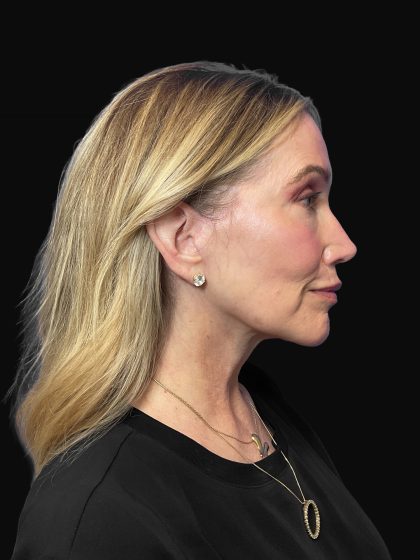 Deep Plane Facelift & Necklift Before & After Patient #1496