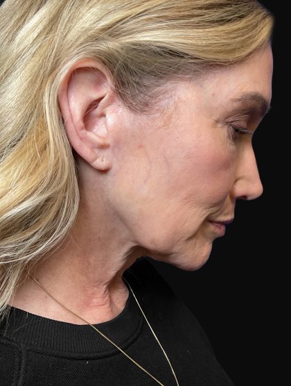 Deep Plane Facelift & Necklift Before & After Patient #1496