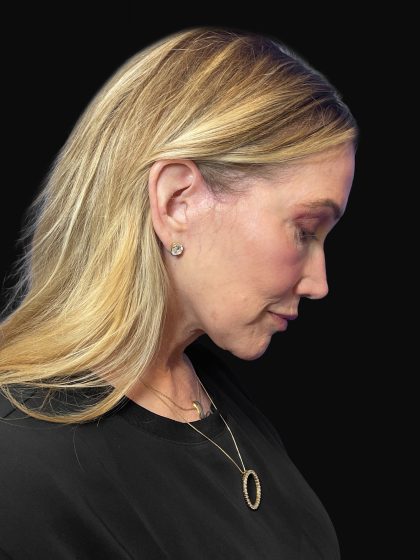Deep Plane Facelift & Necklift Before & After Patient #1496