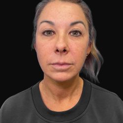 Deep Plane Facelift & Necklift Before & After Patient #1495