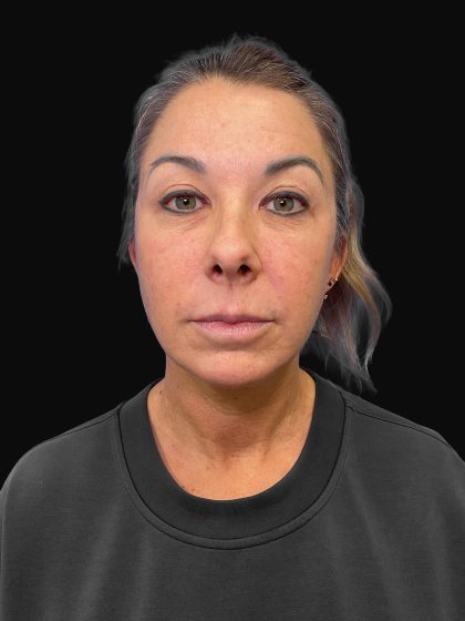 Deep Plane Facelift & Necklift Before & After Patient #1495