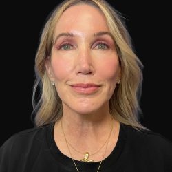 Deep Plane Facelift & Necklift Before & After Patient #1496