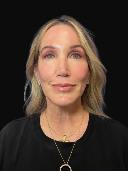 Deep Plane Facelift & Necklift Before & After Patient #1496