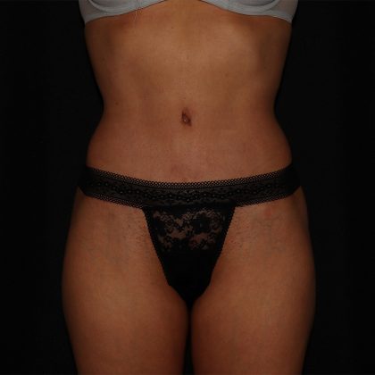 Signature Silhouette (Mommy Makeover) Before & After Patient #1403