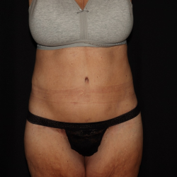 Weight Loss Before & After Patient #1345