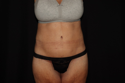 Weight Loss Before & After Patient #1345
