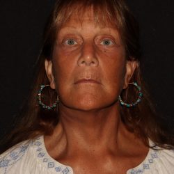 Deep Plane Facelift & Necklift Before & After Patient #1405