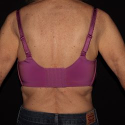 Weight Loss Before & After Patient #1402