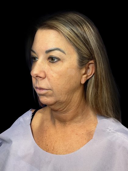 Deep Plane Facelift & Necklift Before & After Patient #1495