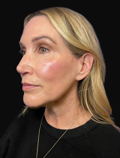 Deep Plane Facelift & Necklift Before & After Patient #1496