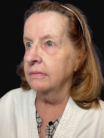 Deep Plane Facelift & Necklift Before & After Patient #1497