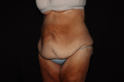 Weight Loss Before & After Patient #1345